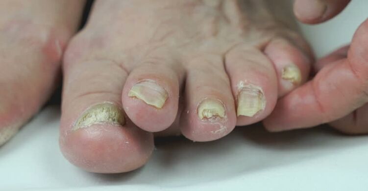 Onychomycosis