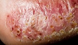 Dermatomikosi