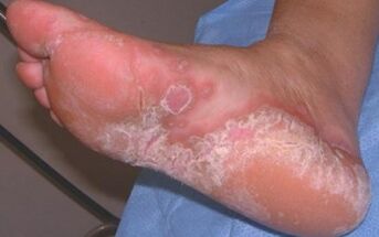 Oinaren dermatomikosi akutua