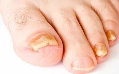 Iltze onddoaren argazki sintomak