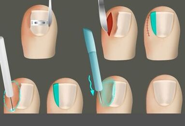 Iltzea hanketan onddo baten aurrean kentzea