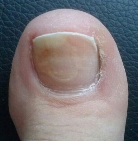 Iltze onddoa thumb