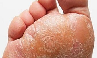 Hanketan onddoen seinaleak eta sintomak