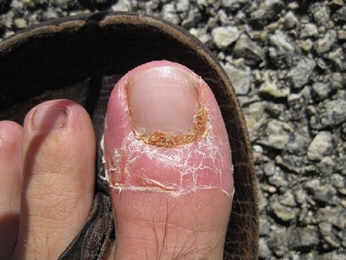 onddoen infekzio baten ondorioz oinetako azazkalak eta azala kaltetzea